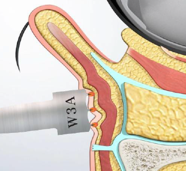 アグネスによる眼窩周囲のシワに対する治療